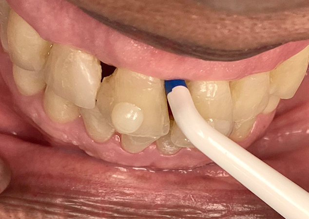 Gauge measuring spacing between teeth