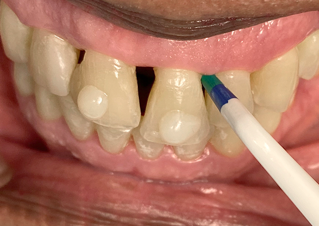 Gauge measuring spacing between teeth