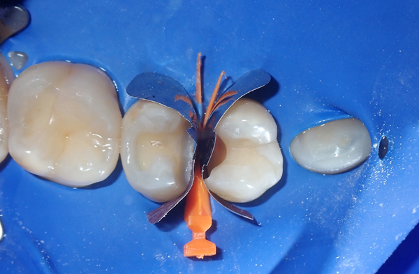 Matrix Bands and Wedge in place