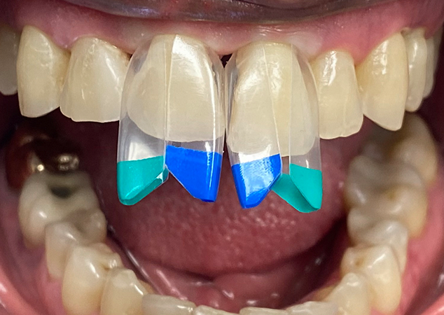 Centre incisors with coloured matrices in place