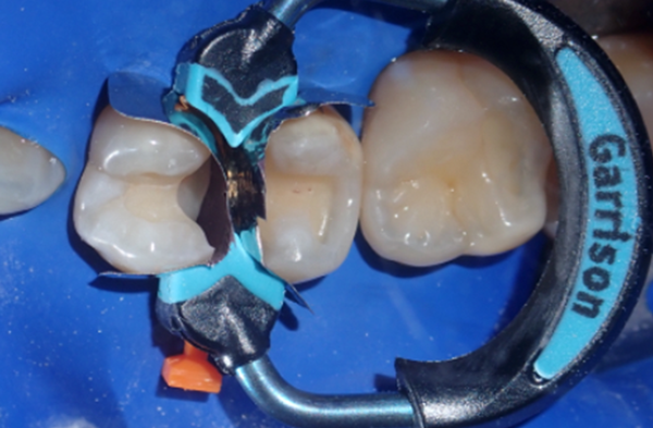 Ring in place along with bands and wedge