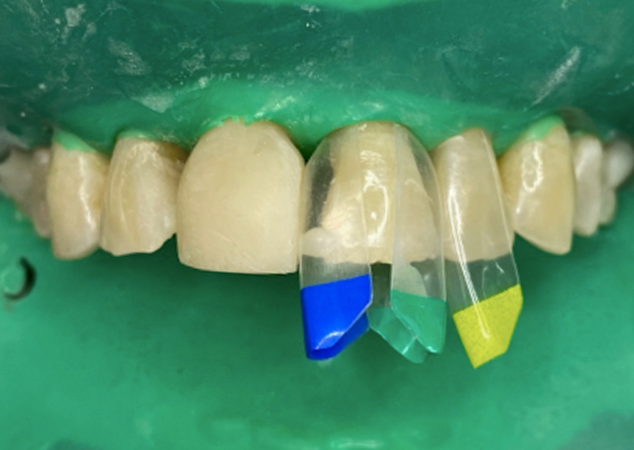 Coloured matrices in place on mouth isolated with green rubber dam