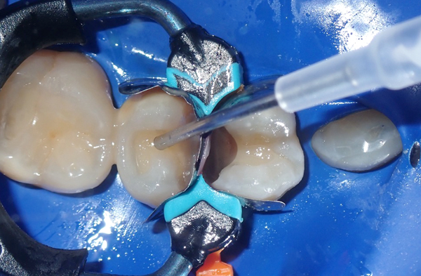 Syringe placing bulk fill composite into tooth