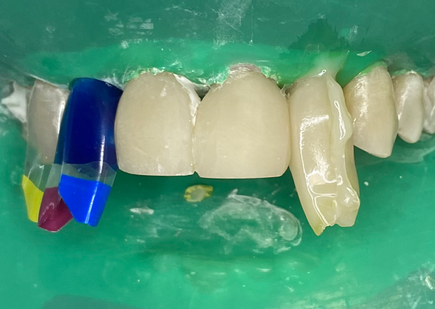 Coloured matrices in place on mouth isolated with green rubber dam