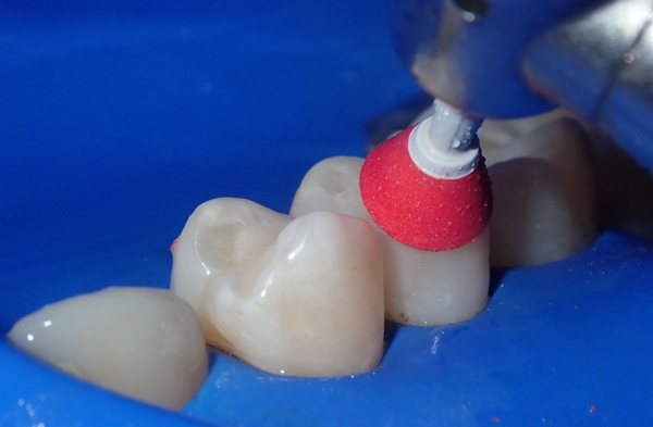 Tooth polishing with red cup