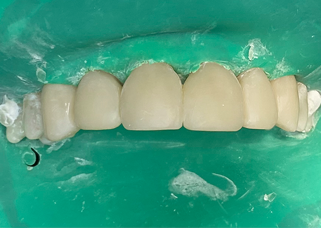 Restored teeth still rubber dam isolated