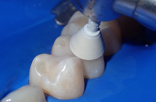 Tooth polishing with white cup