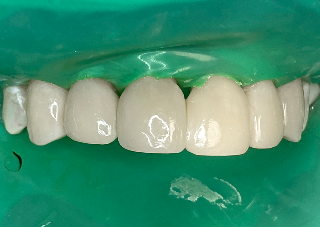 Final restoration after polishing still isolated with rubber dam