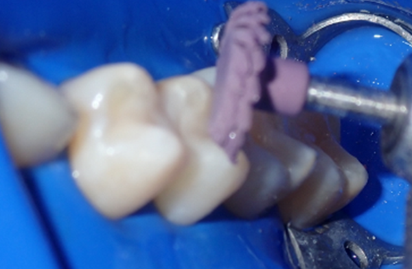 Tooth polishing with purple polisher