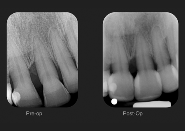Pre and Post Op x-rays