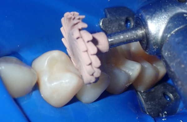 Tooth polishing with peach polisher