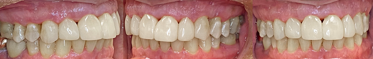 Final restoration result from different angles