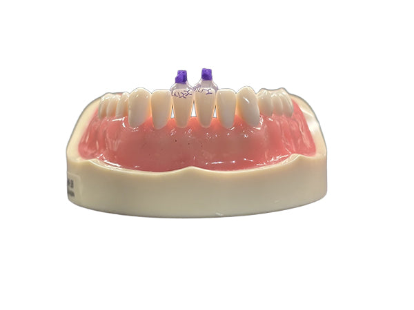 Load image into Gallery viewer, Bioclear™ Tooth &amp; Surface Specific (TSS) Anterior Matrix Refills
