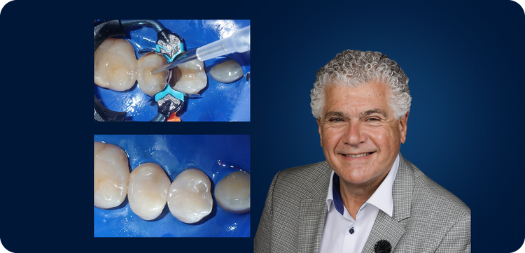 Predictable Class II Back-to-Back Composite Restorations with Evanesce Bulk Cure