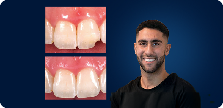 Composite Layering Class IV Fracture Repair Using Nature as a Guide