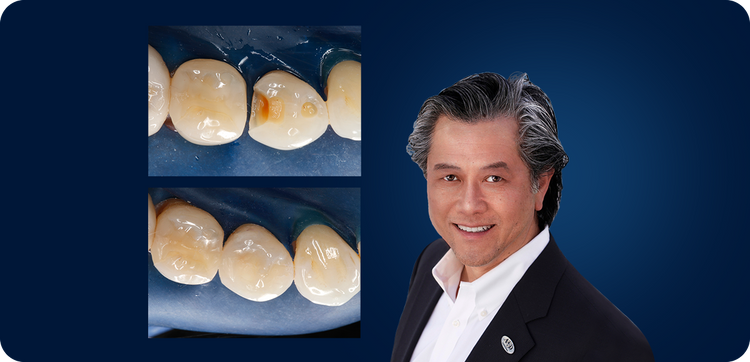 Controlling the Variables for Perfect Class II Restorations