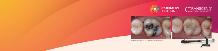 Simply Beautiful Results for Any Restoration!