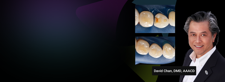 Controlling the Variables for Perfect Class II Restorations