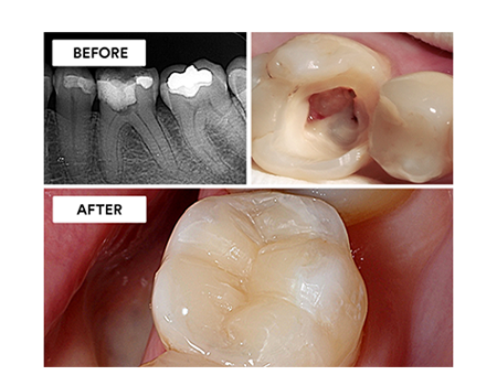 Clinical Case: Root canal treatment and post-endodontic restoration