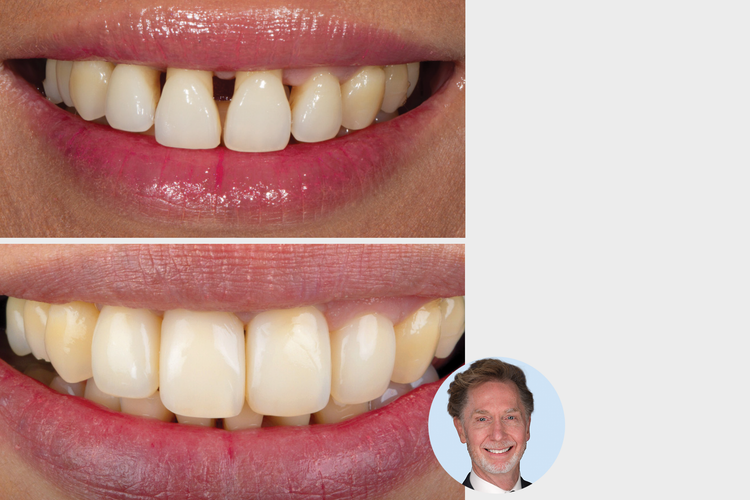 From Mild to Wild: Treating Simple and Extreme Black Triangle Cases with Bioclear