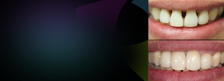 Treating Simple and Extreme Black Triangle Cases with Bioclear